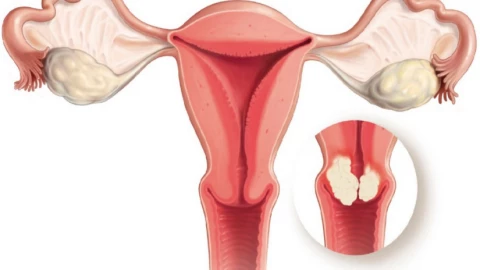 U xơ tử cung có tái phát sau phẫu thuật? Đây là những điều bạn cần biết