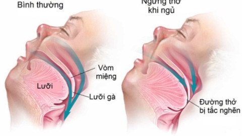 Hội chứng ngưng thở khi ngủ là gì? Nguy hiểm như thế nào?