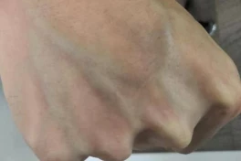 Gân xanh nổi rõ khi nào là bình thường, khi nào là dấu hiệu bệnh?