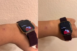 Người dùng Apple Watch Series 12 và Ultra 4 phản ánh tình trạng kích ứng da