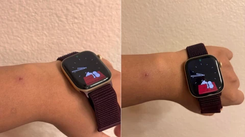 Người dùng Apple Watch Series 12 và Ultra 4 phản ánh tình trạng kích ứng da