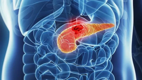 Bệnh nhân ung thư tuyến tụy có thêm hy vọng mới