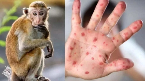 Quá khẩn cấp! WHO phải ban bố tình trạng khẩn cấp toàn cầu lần thứ 2 vì 1 căn bệnh này