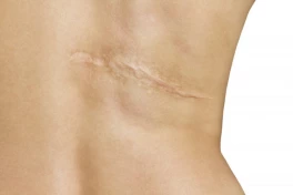 Phát hiện mới đột phá về quá trình liền sẹo