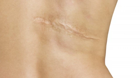 Phát hiện mới đột phá về quá trình liền sẹo