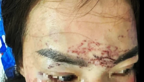 Công an vào cuộc điều tra vụ đánh ghen kinh hoàng – xăm mặt, tạt axit nghi do ghen tuông