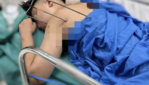 Đinh ba đâm trúng tim, máu tràn phổi – Nam sinh sống sót thần kỳ khiến bác sĩ cũng sửng sốt