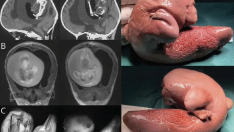 Thai nhi được lấy ra khỏi não của bé gái một tuổi