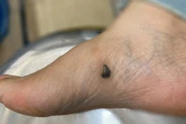 Nốt ruồi có những dấu hiệu này nên đi khám ung thư