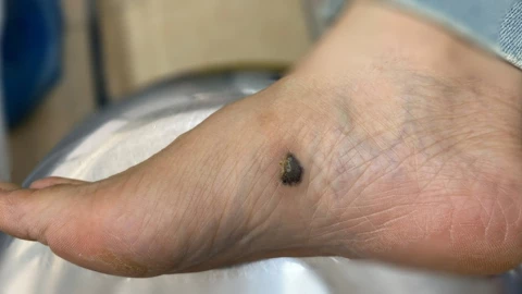 Nốt ruồi có những dấu hiệu này nên đi khám ung thư