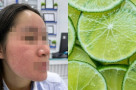 Bỏng da mặt vì dùng 'chanh liều cao' trị mụn