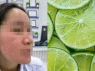 Bỏng da mặt vì dùng 'chanh liều cao' trị mụn