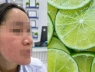 Bỏng da mặt vì dùng 'chanh liều cao' trị mụn