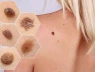 Tổn thương màu đỏ hoặc tím có thể là dấu hiệu của ung thư da
