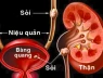 Phát hiện sỏi khi quá muộn: Vì sao nên khám sức định kỳ?