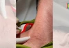 Đã có 26 người mắc giun rồng trong cả nước. Giun rồng là gì? Mắc giun rồng nguy hiểm không?