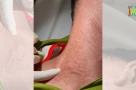 Đã có 26 người mắc giun rồng trong cả nước. Giun rồng là gì? Mắc giun rồng nguy hiểm không?