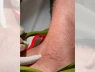 Đã có 26 người mắc giun rồng trong cả nước. Giun rồng là gì? Mắc giun rồng nguy hiểm không?