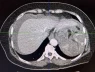 Chụp CT ổ bụng: Dùng để chẩn đoán gì và cách đọc kết quả ra sao?