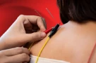 Điện châm là gì? Và liệu nó có hiệu quả không?