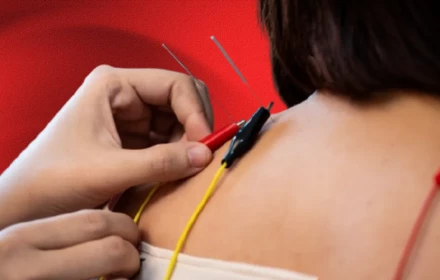 Điện châm là gì? Và liệu nó có hiệu quả không?