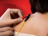 Điện châm là gì? Và liệu nó có hiệu quả không?