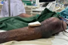 Người đàn ông ở Thanh Hóa nguy cơ hoại tử toàn thân chỉ trong 24h sau khi bị... gai đâm vào chân
