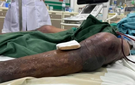 Người đàn ông ở Thanh Hóa nguy cơ hoại tử toàn thân chỉ trong 24h sau khi bị... gai đâm vào chân
