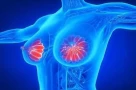 Tăng sản vú là gì? Liệu có dẫn đến ung thư vú không?