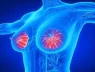 Tăng sản vú là gì? Liệu có dẫn đến ung thư vú không?