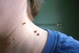 7 triệu chứng trên da cảnh báo gan nhiễm mỡ