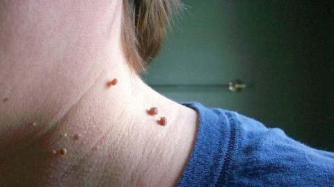 7 triệu chứng trên da cảnh báo gan nhiễm mỡ