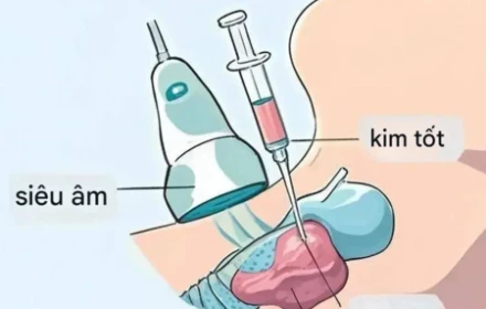 Không phải nốt tuyến giáp nào cũng cần sinh thiết. Vậy làm thế nào tôi biết nên hay không?