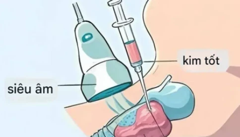 Không phải nốt tuyến giáp nào cũng cần sinh thiết. Vậy làm thế nào tôi biết nên hay không?