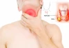 Ai có nguy cơ mắc ung thư tuyến giáp?