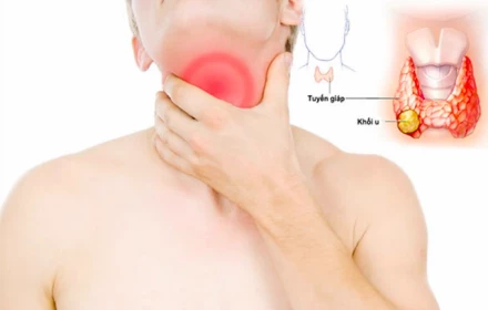 Ai có nguy cơ mắc ung thư tuyến giáp?