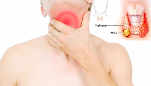 Ai có nguy cơ mắc ung thư tuyến giáp?