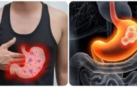 5 triệu chứng buổi sáng cảnh báo ung thư dạ dày