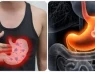 5 triệu chứng buổi sáng cảnh báo ung thư dạ dày