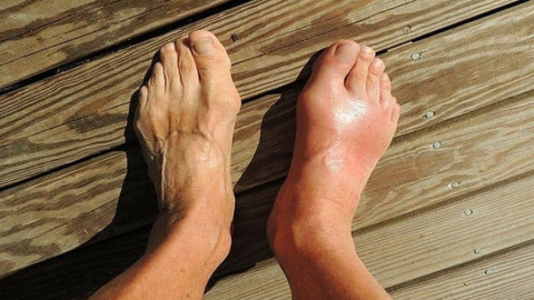 Sai! Sai hết rồi! Chúng ta đã hiểu nhầm về bệnh gout bao lâu nay