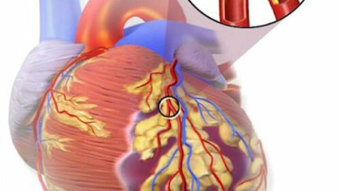 Nhồi máu cơ tim là bệnh gì, nguy hiểm đến mức nào mà có thể khiến một người khỏe mạnh đột ngột qua đời?