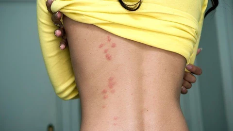 Gãi sột soạt khi bị muỗi đốt? Mách bạn 10 cách làm dịu cơn ngứa cực đơn giản