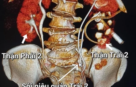 Bác sĩ Bệnh viện E phát hiện bệnh nhân có 4 quả thận. Vì sao có dư hai quả? Và có hiến bớt được không?