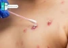 Người đàn ông đi cấp cứu với dấu hiệu lạ ở v.ùng kín