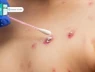 Người đàn ông đi cấp cứu với dấu hiệu lạ ở v.ùng kín