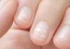 Các đốm trắng trên móng tay có phải do thiếu canxi không?