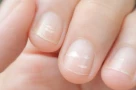 Các đốm trắng trên móng tay có phải do thiếu canxi không?