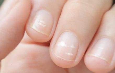 Các đốm trắng trên móng tay có phải do thiếu canxi không?