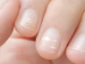 Các đốm trắng trên móng tay có phải do thiếu canxi không?