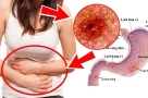 Viêm dạ dày ruột cấp tính là gì và cách phòng tránh trong mùa hè